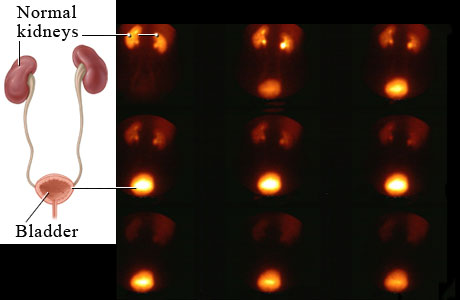 Normal kidney nuclear medicine scan