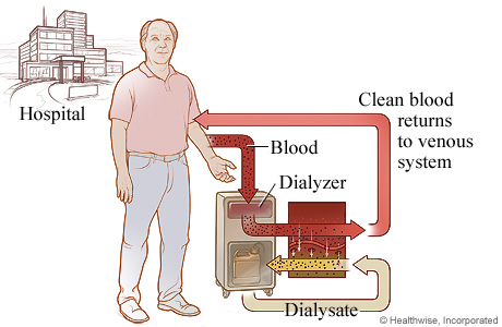 The process of hemodialysis.