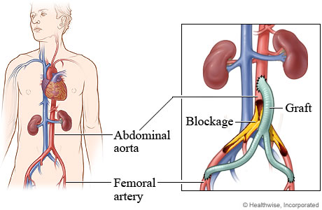 Abdominal and femoral arteries with detail of a blockage and a graft.