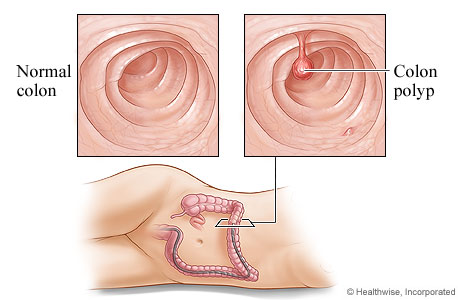 A healthy colon and a colon polyp