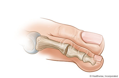 Straightened toe after bone section has been removed