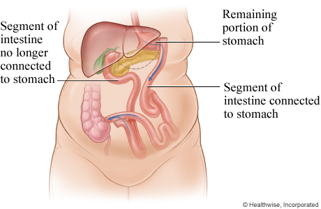 Biliopancreatic diversion