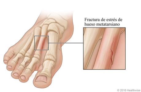 Skeletal view of foot, with detail of stress fracture in metatarsal bone