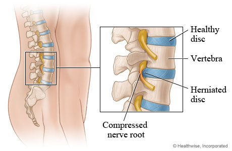 Picture of a herniated disc (side view)