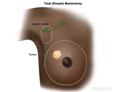 Total (simple) mastectomy; drawing shows removal of the whole breast and some of the lymph nodes under the arm.