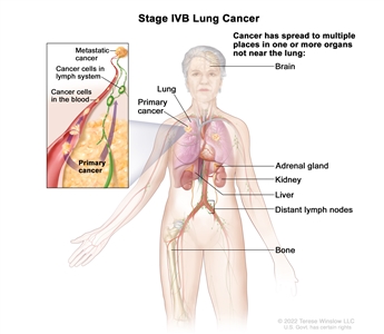 Stage IVB lung cancer; drawing shows a primary cancer in the right lung and other parts of the body where lung cancer may spread, including the brain, adrenal gland, kidney, liver, distant lymph nodes, and bone. An inset shows cancer cells spreading from the lung, through the blood and lymph system, to another part of the body where metastatic cancer has formed.