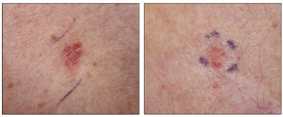 Photographs showing a pink, scaly lesion on the skin (left panel) and flesh-colored nodules on the skin (right panel).