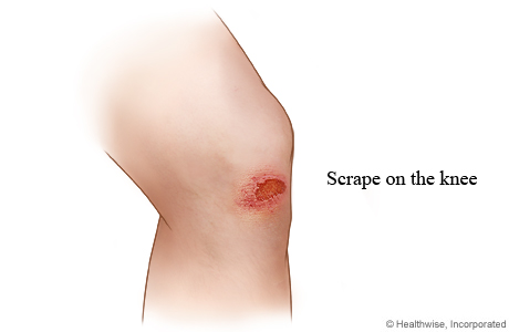 Picture of a scrape on the knee