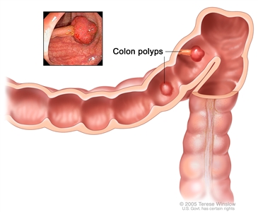 Colon polyps; shows two polyps (one flat and one pedunculated) inside the colon. Inset shows photo of a pedunculated polyp. Colon polyps; shows two polyps (one flat and one pedunculated) inside the colon. Inset shows photo of a pedunculated polyp.