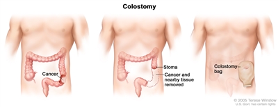 Three-panel drawing showing colon cancer surgery with colostomy; first panel shows the area of the colon with cancer, middle panel shows the cancer and nearby tissue removed and a stoma created, last panel shows a colostomy bag attached to the stoma. Three-panel drawing showing colon cancer surgery with colostomy; first panel shows the area of the colon with cancer, middle panel shows the cancer and nearby tissue removed and a stoma created, last panel shows a colostomy bag attached to the stoma.
