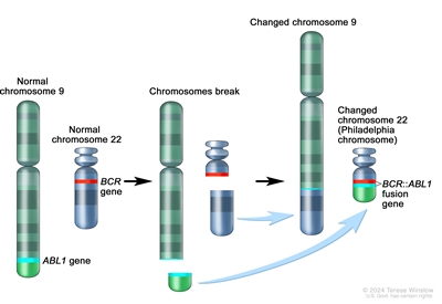 Philadelphia chromosome; three-panel drawing shows a piece of chromosome 9 and a piece of chromosome 22 breaking off and trading places, creating a changed chromosome 22 called the Philadelphia chromosome. In the left panel, the drawing shows a normal chromosome 9 with the abl gene and a normal chromosome 22 with the bcr gene. In the center panel, the drawing shows chromosome 9 breaking apart in the abl gene and chromosome 22 breaking apart below the bcr gene. In the right panel, the drawing shows chromosome 9 with the piece from chromosome 22 attached and chromosome 22 with the piece from chromosome 9 containing part of the abl gene attached. The changed chromosome 22 with bcr-abl gene is called the Philadelphia chromosome. Philadelphia chromosome; three-panel drawing shows a piece of chromosome 9 and a piece of chromosome 22 breaking off and trading places, creating a changed chromosome 22 called the Philadelphia chromosome. In the left panel, the drawing shows a normal chromosome 9 with the abl gene and a normal chromosome 22 with the bcr gene. In the center panel, the drawing shows chromosome 9 breaking apart in the abl gene and chromosome 22 breaking apart below the bcr gene. In the right panel, the drawing shows chromosome 9 with the piece from chromosome 22 attached and chromosome 22 with the piece from chromosome 9 containing part of the abl gene attached. The changed chromosome 22 with bcr-abl gene is called the Philadelphia chromosome.