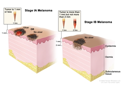 Two-panel drawing of stage I melanoma. The first panel shows a stage IA tumor that is not more than 1 millimeter thick, with no ulceration (break in the skin). The second panel shows two stage IB tumors. One tumor is not more than 1 millimeter thick, with ulceration, and the other tumor is more than 1 but not more than 2 millimeters thick, with no ulceration. Also shown are the epidermis (outer layer of the skin), the dermis (inner layer of the skin), and the subcutaneous tissue below the dermis. Two-panel drawing of stage I melanoma. The first panel shows a stage IA tumor that is not more than 1 millimeter thick, with no ulceration (break in the skin). The second panel shows two stage IB tumors. One tumor is not more than 1 millimeter thick, with ulceration, and the other tumor is more than 1 but not more than 2 millimeters thick, with no ulceration. Also shown are the epidermis (outer layer of the skin), the dermis (inner layer of the skin), and the subcutaneous tissue below the dermis.