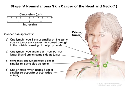 Stage IV nonmelanoma skin cancer (1); drawing shows a primary tumor in one arm with cancer in a lymph node on the same side of the body as the primary tumor. Insets show 3 centimeters is about the size of a grape and 6 centimeters is about the size of an egg. Stage IV nonmelanoma skin cancer (1); drawing shows a primary tumor in one arm with cancer in a lymph node on the same side of the body as the primary tumor. Insets show 3 centimeters is about the size of a grape and 6 centimeters is about the size of an egg.