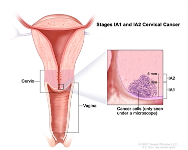 Stage IA1 and IA2 cervical cancer; drawing shows a cross-section of the cervix and vagina. An inset shows cancer in the cervix that is up to 5 mm deep, but not more than 7 mm wide. Stage IA1 and IA2 cervical cancer; drawing shows a cross-section of the cervix and vagina. An inset shows cancer in the cervix that is up to 5 mm deep, but not more than 7 mm wide.