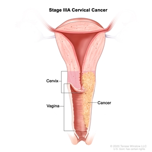 Stage IIIA cervical cancer; drawing shows a cross-section of the cervix and vagina. Cancer is shown in the cervix and in the full length of the vagina. Stage IIIA cervical cancer; drawing shows a cross-section of the cervix and vagina. Cancer is shown in the cervix and in the full length of the vagina.