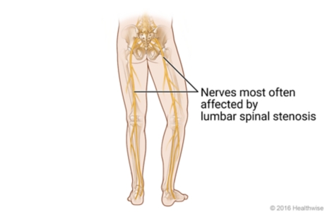Location of nerves down legs that are most often affected by lumbar spinal stenosis