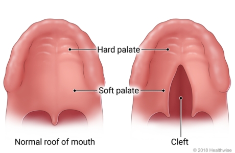 Location of hard palate and soft palate on roof of mouth, showing normal roof of mouth and one with cleft in soft palate