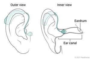 Outer and inner view of mini BTE hearing aid placed in ear.