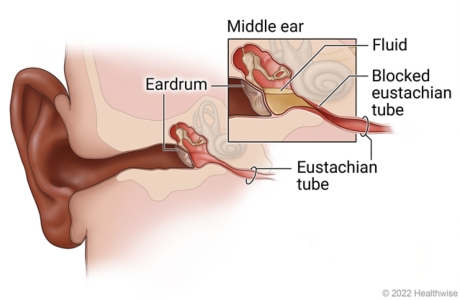 Ear anatomy showing eardrum, middle ear, and eustachian tube, with detail of fluid buildup caused by blocked eustachian tube.
