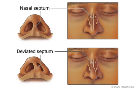 Normal nasal septum and a deviated septum, with views of both looking at head tilted back showing nostrils and at front of face.