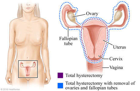 Total hysterectomy and total hysterectomy with removal of ovaries and fallopian tubes