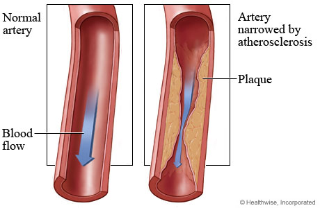 Normal artery and blood flow and an artery narrowed by atherosclerosis
