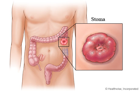 A stoma for a colostomy