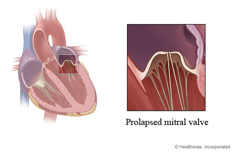 Location of mitral valve in heart showing prolapsed valve that bulges back into the upper chamber