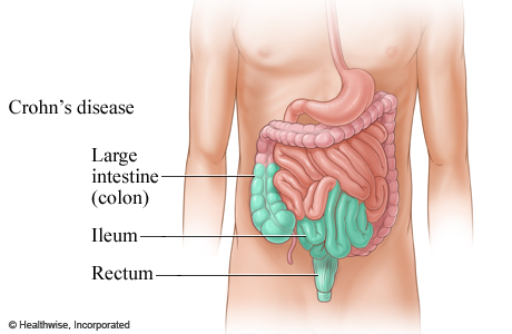 Crohn's disease in part of the digestive tract.
