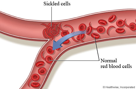 Sickled cells blocking a blood vessel