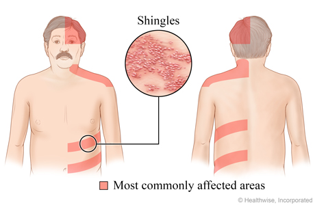Close-up of shingles rash and where shingles usually appears: top half of the head, neck and shoulders, and the belly or back area