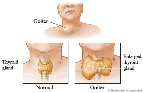 Inside views of a normal thyroid gland and an enlarged thyroid gland (goiter)