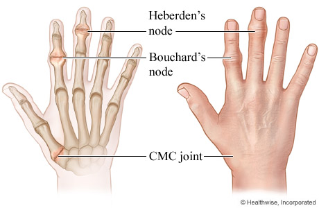 Heberden's and Bouchard's nodes and CMC joint