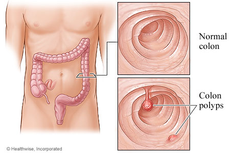 Colon polyps and the location of the colon