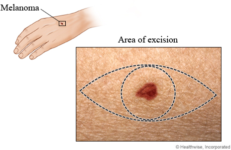 Area of excision for melanoma