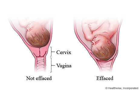 Cervical effacement