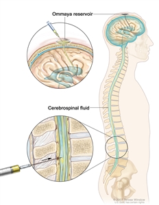 Intrathecal chemotherapy; drawing shows the cerebrospinal fluid (CSF) in the brain and spinal cord, and an Ommaya reservoir (a dome-shaped container that is placed under the scalp during surgery; it holds the drugs as they flow through a small tube into the brain). Top section shows a syringe and needle injecting anticancer drugs into the Ommaya reservoir. Bottom section shows a syringe and needle injecting anticancer drugs directly into the cerebrospinal fluid in the lower part of the spinal column.