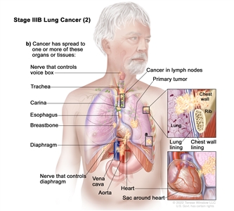 Stage IIIB lung cancer (2); drawing shows a primary tumor in the left lung and (a) a separate tumor in a different lobe of the lung with the primary tumor. Also shown is cancer in lymph nodes on the same side of the chest as the primary tumor. The lymph nodes with cancer are around the trachea or where the trachea divides into the bronchi. Also shown is (b) cancer that has spread to the following: the chest wall and the lining of the chest wall and lung, the nerve that controls the voice box, the trachea, the carina, the esophagus, the breastbone, the diaphragm, the nerve that controls the diaphragm, the aorta and vena cava, the heart, and the sac around the heart.