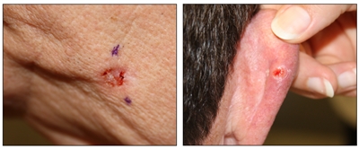 Photographs showing a red, ulcerated lesion on the skin of the face (left panel) and a red, ulcerated lesion surrounded by a white border on the skin of the back of the right ear (right panel).