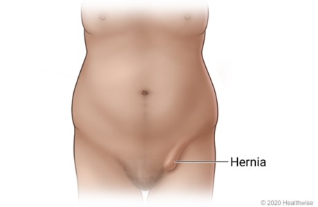 Bulge of inguinal hernia in groin area