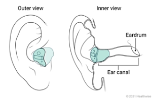 Outer and inner views of in-the-canal hearing aid placed in ear.