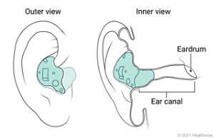 Outer and inner views of in-the-ear hearing aid placed in ear.