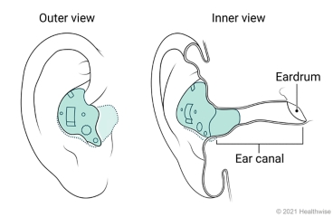 Outside and inside views of an in-the-ear hearing aid placed in ear.