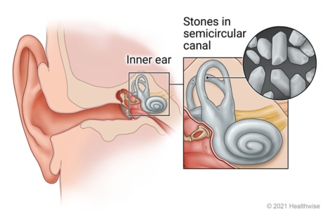 Ear anatomy, showing detail of inner ear and semicircular canals, with close-up of stones in canal.