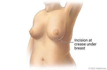 Breast showing incision site at crease under breast for nipple-sparing mastectomy with inframammary cut.