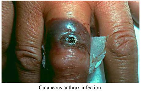 Photo of a cutaneous anthrax infection on a veterinarian's hand