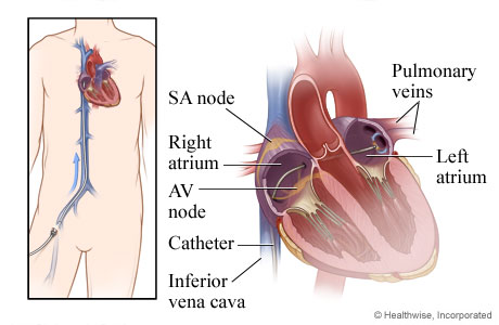 How a catheter is inserted through a vein to the heart.