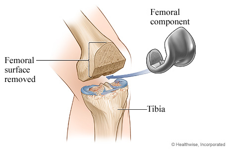 Knee replacement surgery: Femoral component