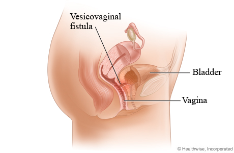 Picture of a vesicovaginal fistula