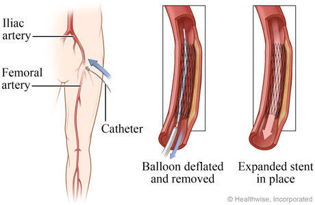 Deflated balloon removed and expanded stent in place